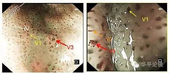 6个精彩病例带你领略早期食管癌的内镜下诊治