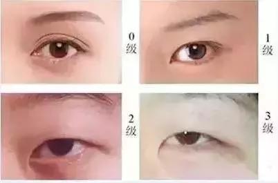 开内眼角和外眼角哪个好看,外眼角上扬适合开外眼角吗