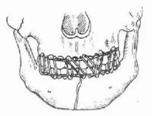 面部摔伤多处骨折注意事项,脸部跌伤骨折怎样处理