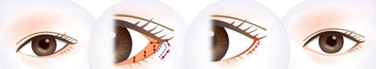 下眼睑下垂术后眼睛会恢复吗,眼睑下至手术前后对比图