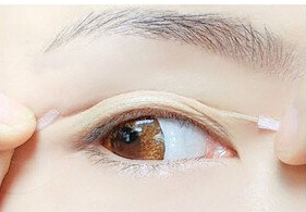 双眼皮最快做法,如何快速的自然形成双眼皮
