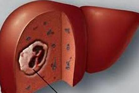 肝癌疼痛和胆囊炎疼痛的区别,脂肪肝疼痛和肝癌疼痛区别
