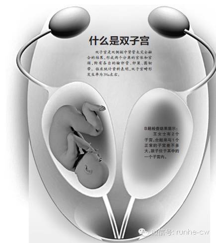 孕6月准妈妈肚子惊现两个子宫，跪求医生挽救不成竟被迫含泪引产