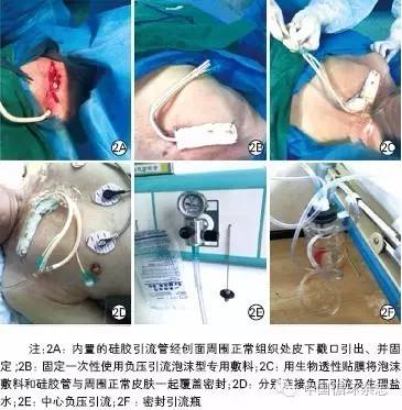 术中如何预防起搏器囊袋感染,起搏器植入术后囊袋感染症状