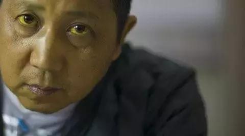 大柴胡汤治疗黄疸吗,黄疸性肝炎喝小柴胡汤可以吗