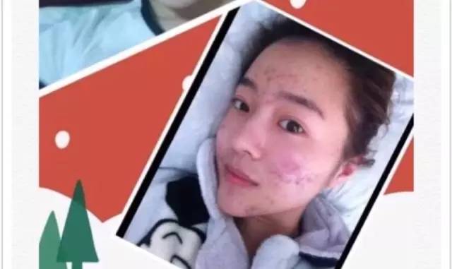 痘痘痘印黑头日常推荐,去黑头痘痘教程