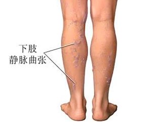 静脉曲张弹力袜治疗型1级2级区别,小腿静脉曲张穿弹力袜管用吗