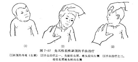 宝宝斜颈需要干预吗,宝宝斜颈家里治疗