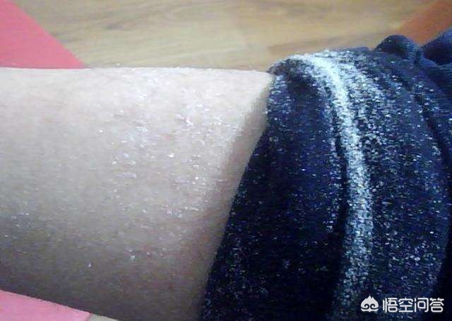 冬天到了身上会有雪花一样的皮屑,北方冬天天气干燥身上掉皮屑