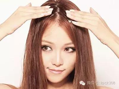 前额头脂溢性脱发最佳治疗方法,头发中间秃了怎么回事脂溢性脱发