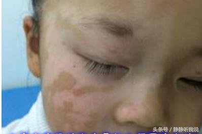 白癜风怎么才能有效控制,白癜风如何有效控制白癜风扩散