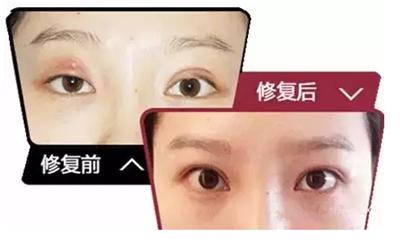 埋线双眼皮失败怎样恢复,埋线双眼皮做失败后怎么修复
