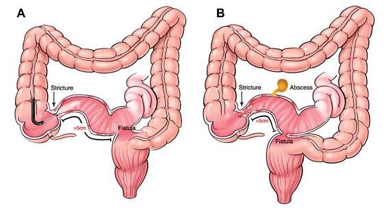 克罗恩病内镜严重程度指数,克罗恩病内镜检查是怎么样的