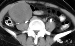 病例丨病理结果「医看」有奖阅片大赛病例资料8：右侧卵巢纤维瘤#医学影像#