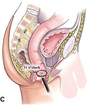 克罗恩病内镜严重程度指数,克罗恩病内镜检查是怎么样的