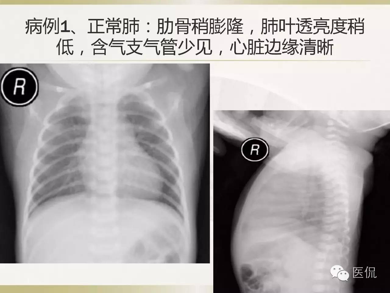 「资料丨医看分享」南边老师肺部群：新生儿透明膜病（HMD）医学影像