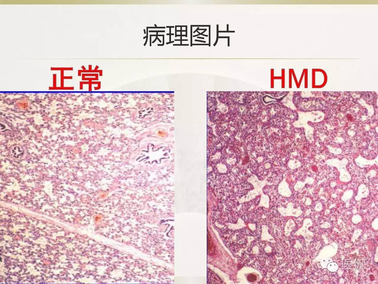 「资料丨医看分享」南边老师肺部群：新生儿透明膜病（HMD）医学影像