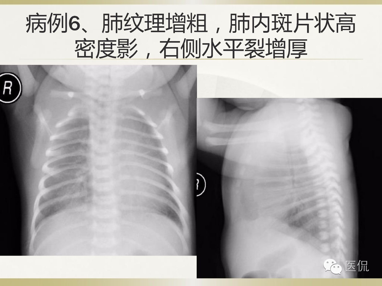 「资料丨医看分享」南边老师肺部群：新生儿透明膜病（HMD）医学影像
