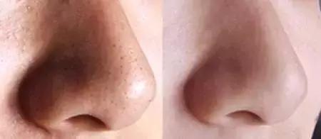 草莓鼻擦什么药有效,去草莓鼻最有效的产品