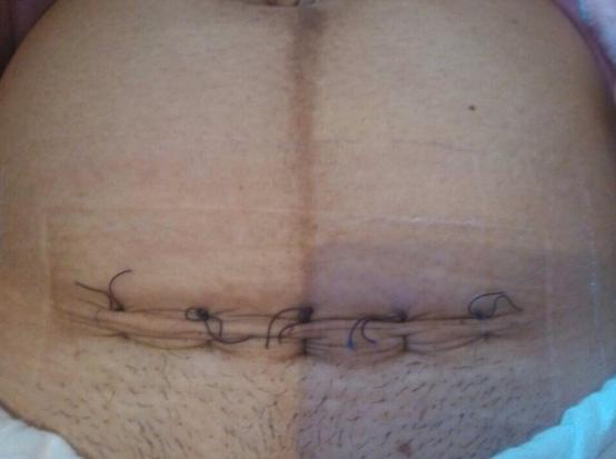 剖腹产要经过几道工序,剖腹产只需切一层