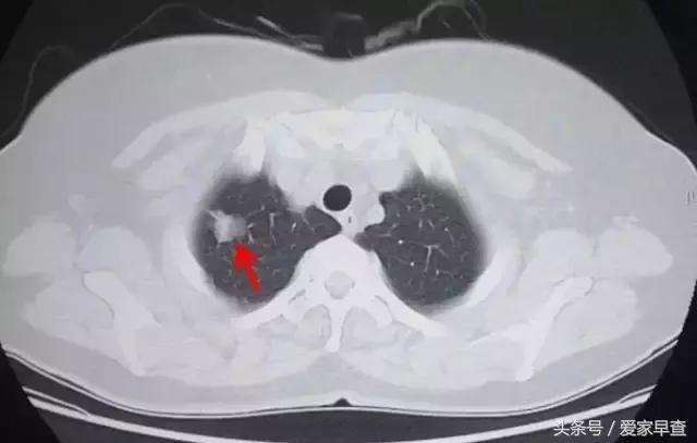 布什还是奥巴马？放射科杨大夫谈体检查出的结节和囊肿