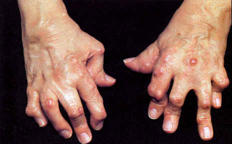 孕妇类风湿关节炎可以用药吗,妊娠期间类风湿病会加重吗