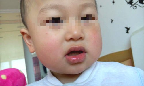 男孩下嘴唇外翻是怎么回事,下嘴唇太厚而且外翻怎么办