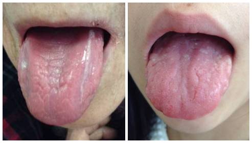 舌头看健康11种舌象代表的疾病,怎样的舌头才是健康的图片