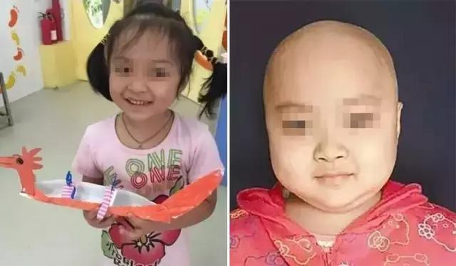 从罗一笑事件来看，白血病为何能导致头发*光脱**