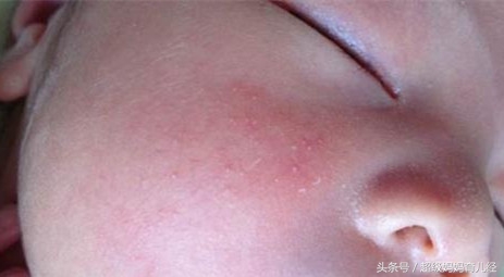 宝宝疹子和湿疹区别,一哭就起疹子是湿疹还是热疹
