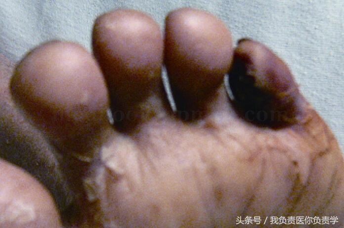 肾移植后坏死能活多久,肾移植后常见的感染部位有哪些