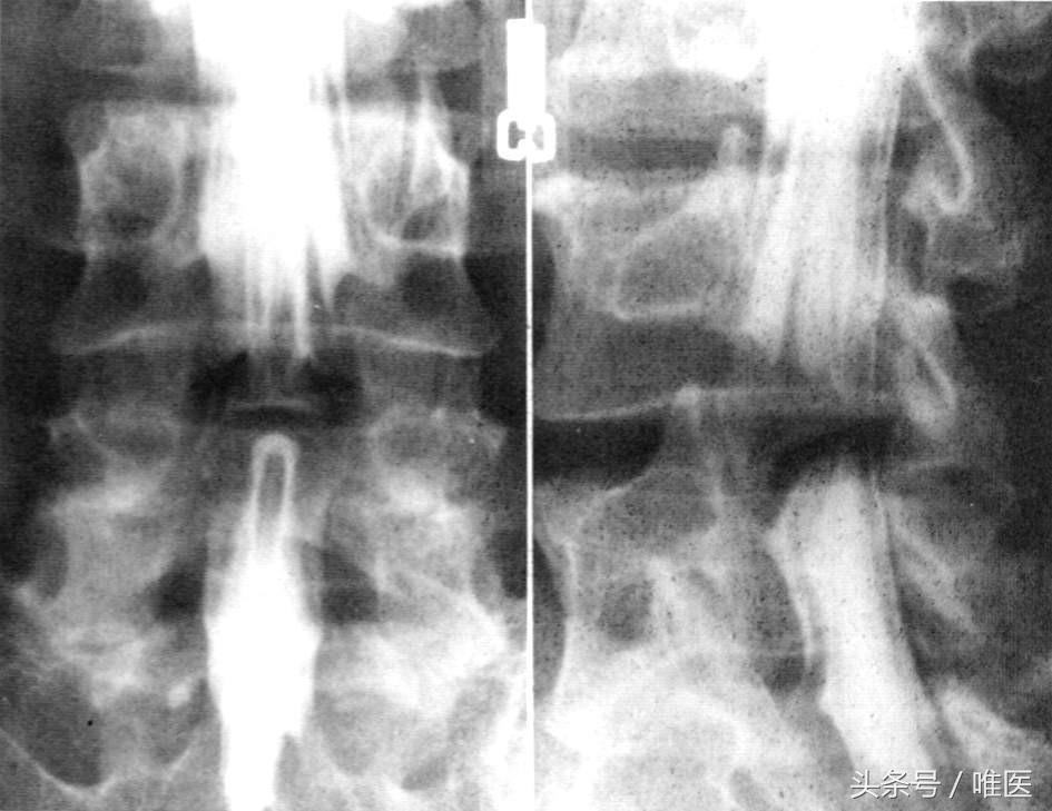 退行性腰椎管狭窄的治疗方法,腰椎管狭窄症初期症状