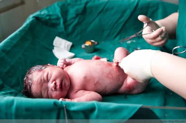 剖腹产恢复很好的照片,剖腹产完全恢复照片