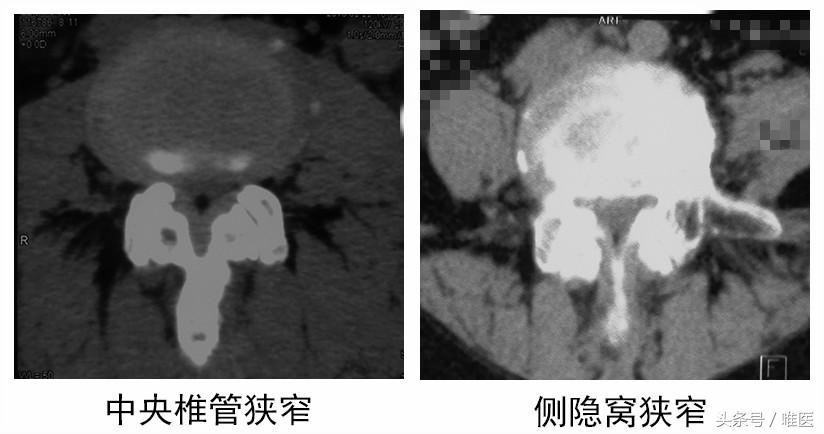 退行性腰椎管狭窄的治疗方法,腰椎管狭窄症初期症状