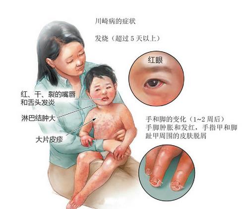 患过川崎病的宝宝感冒了,小儿发烧不咳嗽怀疑川崎病
