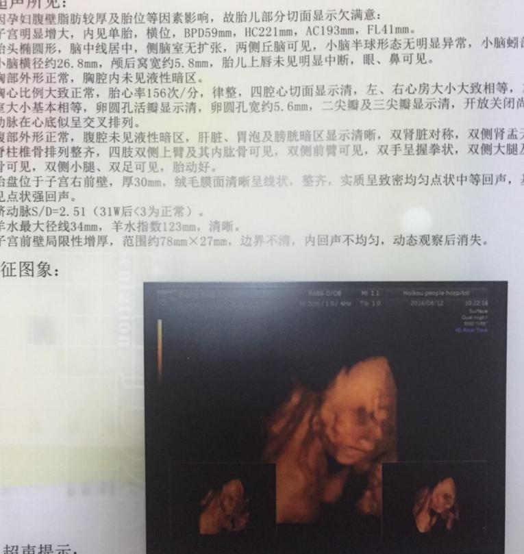 孕38周+2天超快顺产女宝一枚,(无侧切)附上四维和数据症状