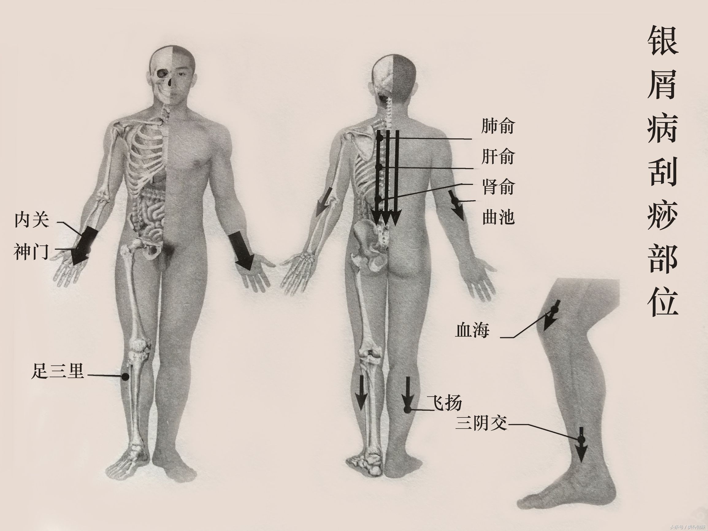 牛皮癣痒用刮痧办法行吗,身上有股癣神经性皮炎银屑病
