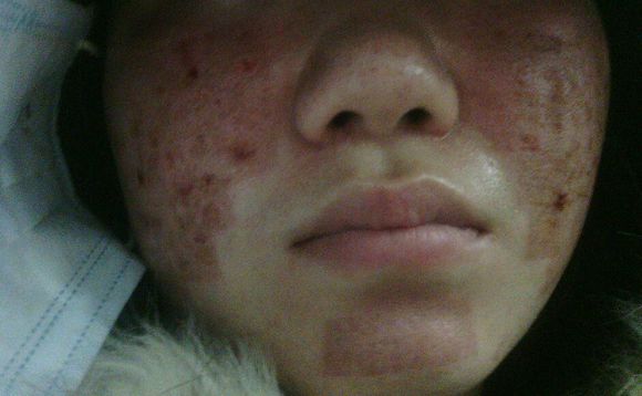 激光祛斑科普你想知道的一切,皮秒和激光哪个祛斑效果最好