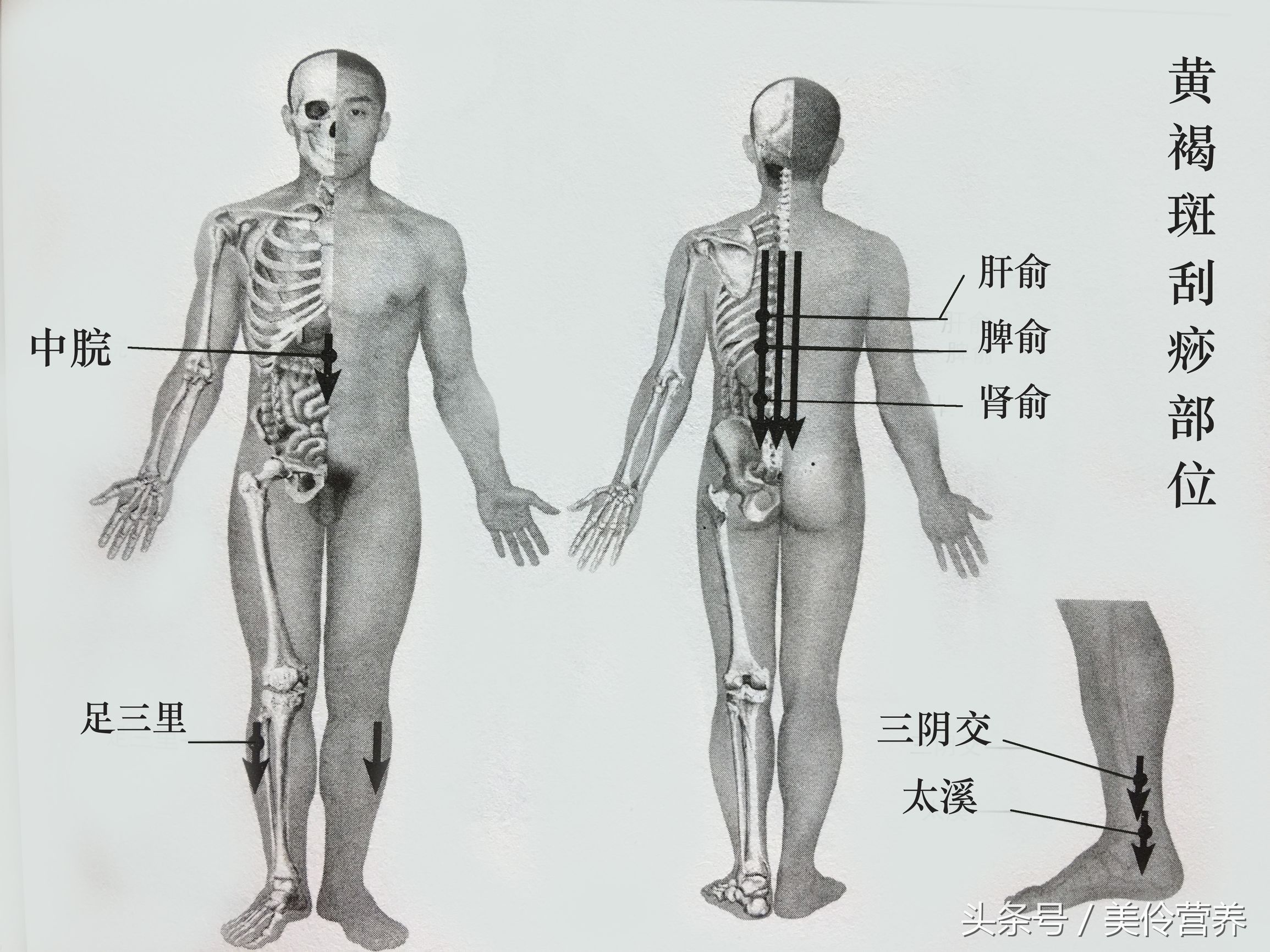 *褐斑黄**、多汗症、多形红斑的刮痧疗法