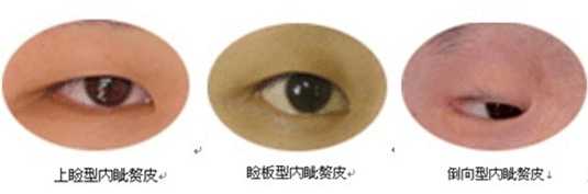 双眼皮的十大问题图,双眼皮割得不好怎么办