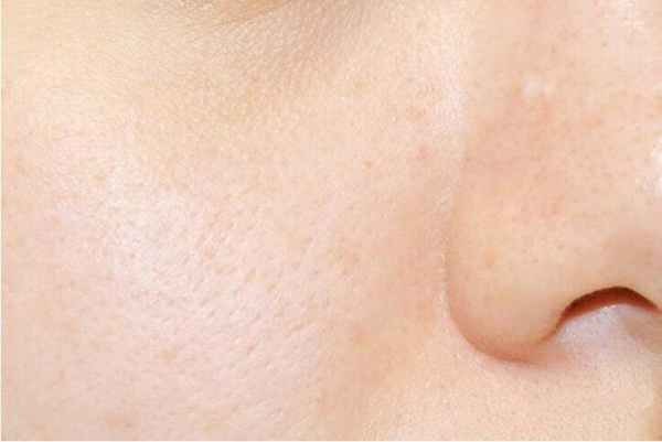 右脸颊长红痘是什么原因引起的,右脸颊一片痘痘