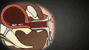 到底是人流还是药流怎么选太纠结,哺乳期选择药流还是人流