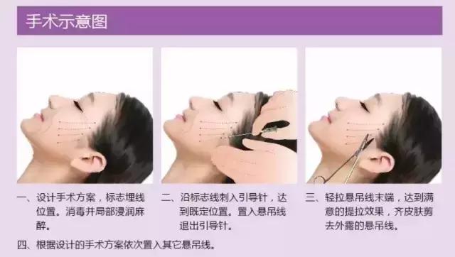 做线雕多久可以敷面膜,敷100次面膜不如打一次水光图片