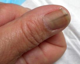 哪种皮肤病容易引起指甲损害,哪些皮肤病会出现指甲的病变