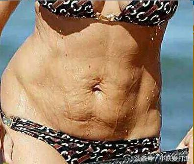 屁股也长妊娠纹,孕中期长妊娠纹用什么祛妊娠纹