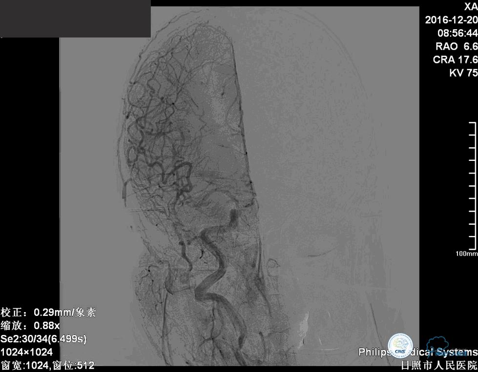 颈动脉瘤介入栓塞康复后可活多久,动脉瘤微创栓塞术全过程