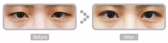 割双眼皮、垫鼻子、幽灵医生……一篇文章为你揭秘韩国整形