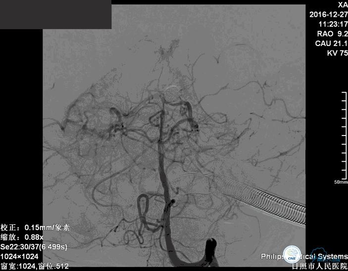 颈动脉瘤介入栓塞康复后可活多久,动脉瘤微创栓塞术全过程