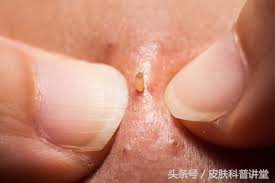 皮肤科医生毛孔粗大推荐的护肤品,毛孔粗大有黑头可以看皮肤科吗