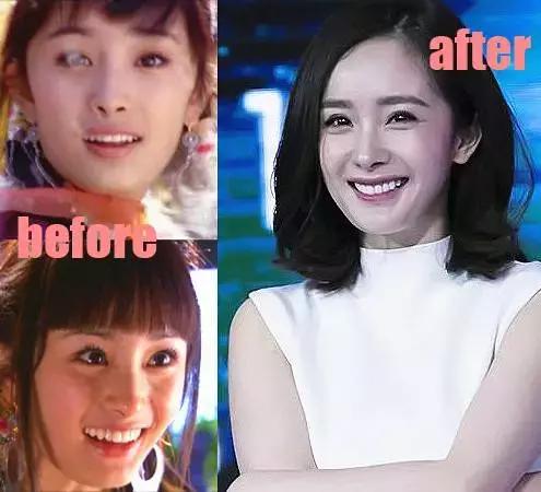 整牙=整容?看杨幂、刘涛、高圆圆为你亲身示范!